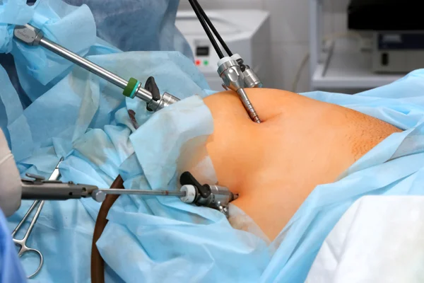 Laparoscopic Hysterectomy